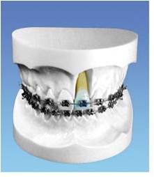 帶方絲托槽的正畸示教模型 帶方絲托槽的正畸示教模型